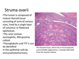 Struma ovarii
•The tumor is composed of
mature thyroid tissue
consisting of acini of various
sizes, lined by a single layer
of columnar or flattened
epithelium.
•The acini contain
eosinophilic, PAS-positive
colloid.
•Thyroglobulin and TTF-1 can
be identified
in the epithelial cells by
immunohistochemistry
The thyroid tissue, which has a microscopically
unremarkable appearance, is sharply delimited
from the ovarian stroma.
 