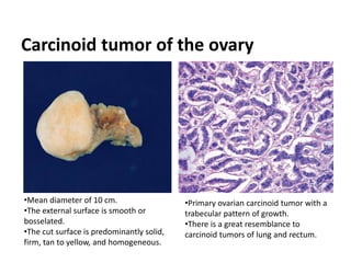 Carcinoid tumor of the ovary
•Mean diameter of 10 cm.
•The external surface is smooth or
bosselated.
•The cut surface is predominantly solid,
firm, tan to yellow, and homogeneous.
•Primary ovarian carcinoid tumor with a
trabecular pattern of growth.
•There is a great resemblance to
carcinoid tumors of lung and rectum.
 