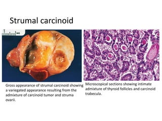 Strumal carcinoid
Gross appearance of strumal carcinoid showing
a variegated appearance resulting from the
admixture of carcinoid tumor and struma
ovarii.
Microscopical sections showing intimate
admixture of thyroid follicles and carcinoid
trabecula.
 