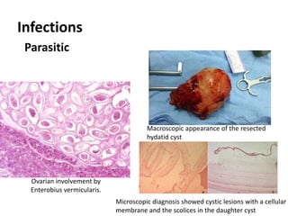Infections
Parasitic
Ovarian involvement by
Enterobius vermicularis.
Microscopic diagnosis showed cystic lesions with a cellular
membrane and the scolices in the daughter cyst
Macroscopic appearance of the resected
hydatid cyst
 