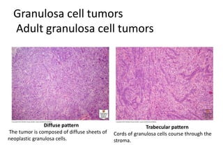 Granulosa cell tumors
Adult granulosa cell tumors
Diffuse pattern
The tumor is composed of diffuse sheets of
neoplastic granulosa cells.
Trabecular pattern
Cords of granulosa cells course through the
stroma.
 