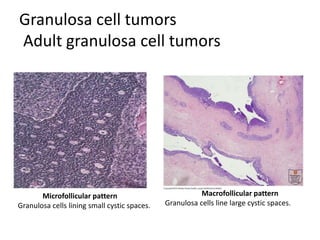 Granulosa cell tumors
Adult granulosa cell tumors
Macrofollicular pattern
Granulosa cells line large cystic spaces.
Microfollicular pattern
Granulosa cells lining small cystic spaces.
 