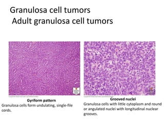 Granulosa cell tumors
Adult granulosa cell tumors
Gyriform pattern
Granulosa cells form undulating, single-file
cords.
Grooved nuclei
Granulosa cells with little cytoplasm and round
or angulated nuclei with longitudinal nuclear
grooves.
 