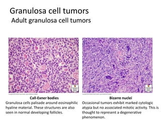 Granulosa cell tumors
Adult granulosa cell tumors
Call-Exner bodies
Granulosa cells palisade around eosinophilic
hyaline material. These structures are also
seen in normal developing follicles.
Bizarre nuclei
Occasional tumors exhibit marked cytologic
atypia but no associated mitotic activity. This is
thought to represent a degenerative
phenomenon.
 