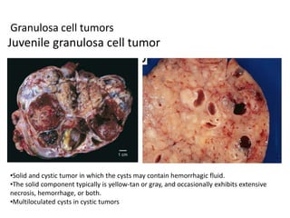 Granulosa cell tumors
Juvenile granulosa cell tumor
•Solid and cystic tumor in which the cysts may contain hemorrhagic fluid.
•The solid component typically is yellow-tan or gray, and occasionally exhibits extensive
necrosis, hemorrhage, or both.
•Multiloculated cysts in cystic tumors
 