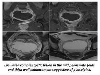ovarian mass evaluation in radiology .pptx