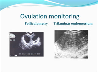 Ovulation monitoring
Folliculometry Trilaminar endometrium
 