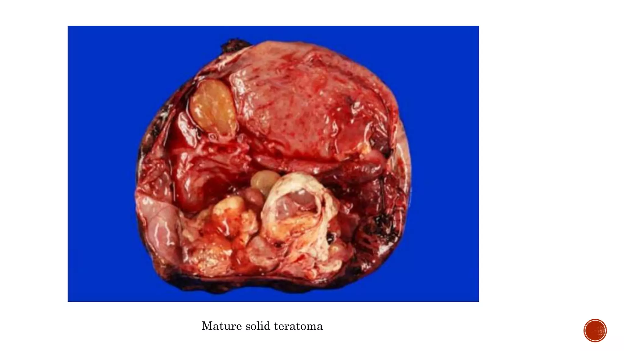 Mature solid teratoma
 