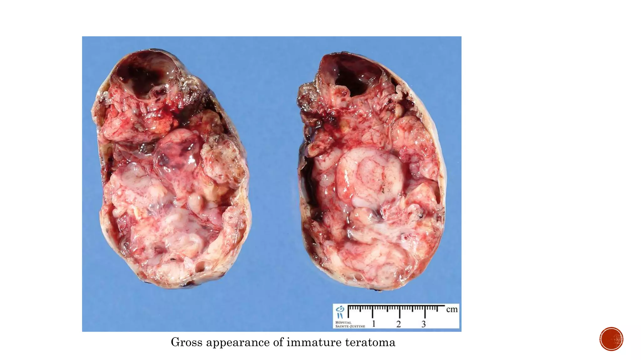 Gross appearance of immature teratoma
 