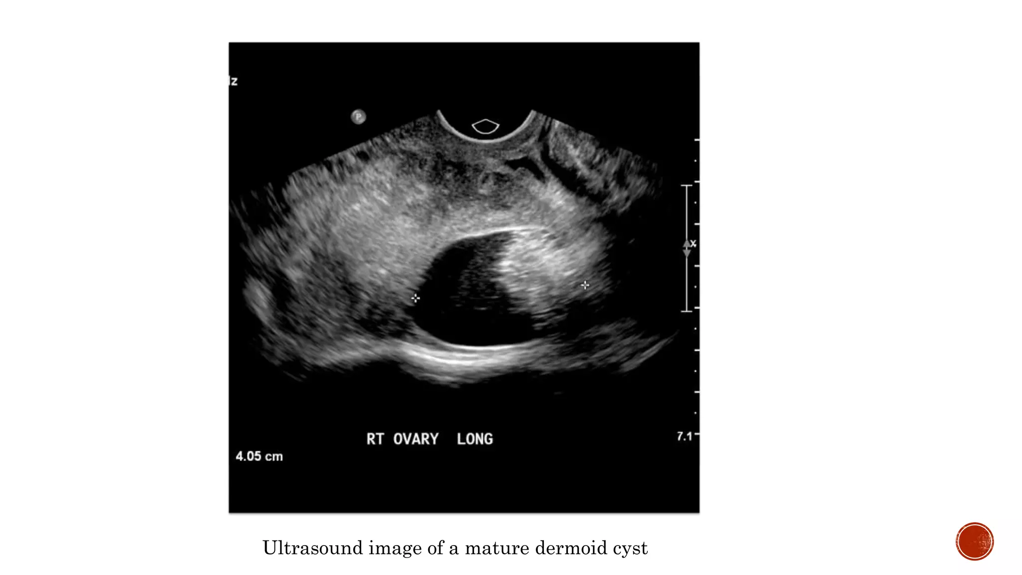 Ultrasound image of a mature dermoid cyst
 