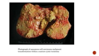 Blood clot
Hemorrhagic cyst
Echogenic bowel
Perforated appendix with appendicolith
Pedunculated lipoleiomyoma of the ...