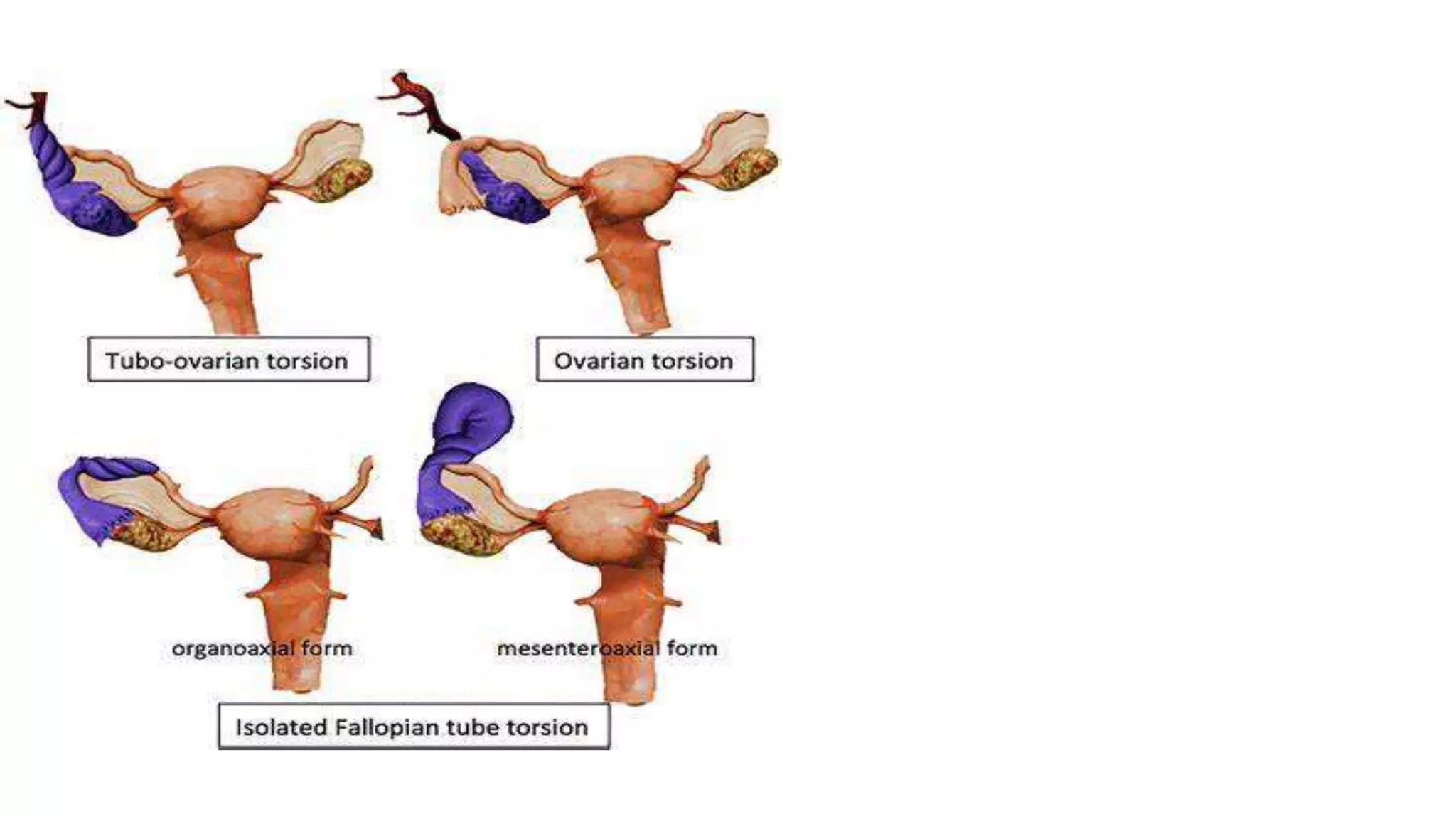 Ovarian Torsion pptx Ovarian Torsion pptx