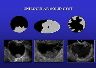 Unilocular-solid
IOTA
 