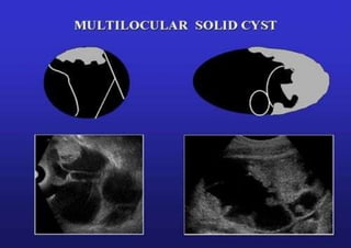 Multilocular-solid
IOTA
 