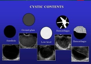 Cystic contents
IOTA
 