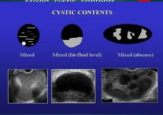 Mixed cystic contents
IOTA
 