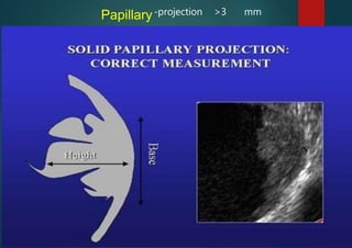 IOTA
-projection >3 mm
Papillary
 