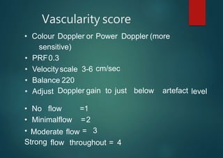 Vascularity score
• Colour Doppler or Power Doppler (more
cm/sec
Doppler gain to just below artefact
sensitive)
• PRF0.3
• Velocityscale 3-6
• Balance 220
• Adjust level
Moderate flow
• No flow =1
• Minimalflow =2
• =
Strong
3
flow throughout = 4
 
