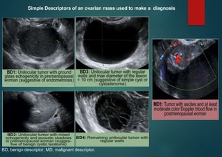 BD, benign descriptor; MD, malignant descriptor.
Simple Descriptors of an ovarian mass used to make a diagnosis
 