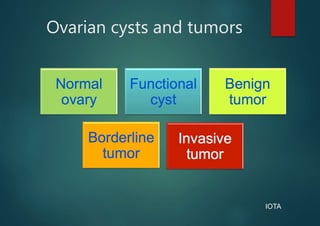 Ovarian cysts and tumors
IOTA
 