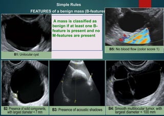Simple Rules
FEATURES of a benign mass (B-features)
A mass is classified as
benign if at least one B-
feature is present and no
M-features are present

 