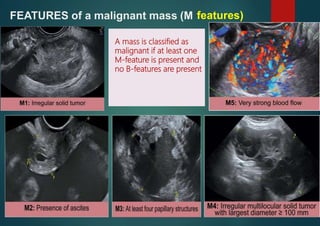 FEATURES of a malignant mass (M features)
A mass is classified as
malignant if at least one
M-feature is present and
no B-features are present
 