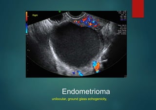 Endometrioma
unilocular, ground glass echogenicity,
 