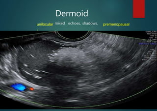 unilocular
,
Dermoid
mixed echoes, shadows, premenopausal
 