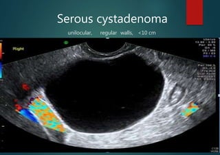 Serous cystadenoma
unilocular, regular walls, <10 cm
 
