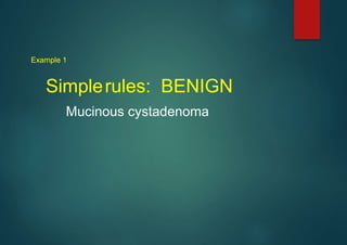 Example 1
Simplerules: BENIGN
Mucinous cystadenoma
 