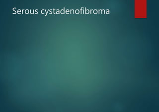 Serous cystadenofibroma
 