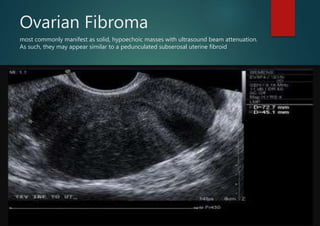 Ovarian Fibroma
most commonly manifest as solid, hypoechoic masses with ultrasound beam attenuation.
As such, they may appear similar to a pedunculated subserosal uterine fibroid
 
