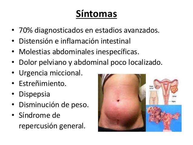 Cancer De Ovario Sintomas