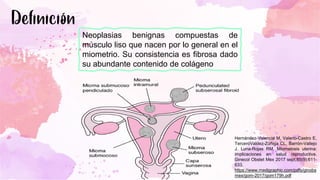 Neoplasias benignas compuestas de
músculo liso que nacen por lo general en el
miometrio. Su consistencia es fibrosa dado
su abundante contenido de colágeno
Hernández-Valencia M, Valerio-Castro E,
TerceroValdez-Zúñiga CL, Barrón-Vallejo
J, Luna-Rojas RM. Miomatosis uterina:
implicaciones en salud reproductiva.
Ginecol Obstet Mex 2017 sept;85(9):611-
633.
https://www.medigraphic.com/pdfs/ginobs
mex/gom-2017/gom179h.pdf
 