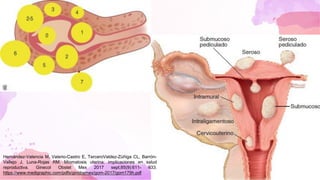 Hernández-Valencia M, Valerio-Castro E, TerceroValdez-Zúñiga CL, Barrón-
Vallejo J, Luna-Rojas RM. Miomatosis uterina: implicaciones en salud
reproductiva. Ginecol Obstet Mex 2017 sept;85(9):611- 633.
https://www.medigraphic.com/pdfs/ginobsmex/gom-2017/gom179h.pdf
 
