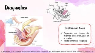 Exploración física
✓ Espéculo en busca de
miomas que protruyan en
el cuello
✓ Tacto bimanual (vaginal)
S. Bendifallah, J.-M. Levaillant, H. Fernandez. Mioma uterino y Fertilidad. Rev. Medica EMC. Elsevier Masson. 2011. volumen 47, paginas 1-25
 