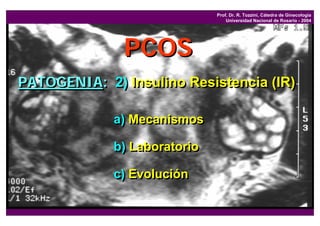 Prof. Dr. R. Tozzini, Cátedra de Ginecología
                                  Universidad Nacional de Rosario - 2004




              PCOS
PATOGENIA: 2) Insulino Resistencia (IR)

             a) Mecanismos

             b) Laboratorio

             c) Evolución
 