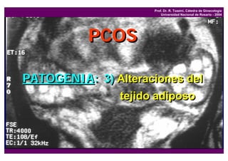 Prof. Dr. R. Tozzini, Cátedra de Ginecología
                          Universidad Nacional de Rosario - 2004




          PCOS

PATOGENIA: 3) Alteraciones del
                tejido adiposo
 