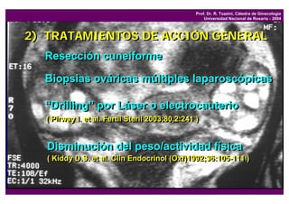 Prof. Dr. R. Tozzini, Cátedra de Ginecología
                                                      Universidad Nacional de Rosario - 2004



2) TRATAMIENTOS DE ACCIÓN GENERAL
  Resección cuneiforme

  Biopsias ováricas múltiples laparoscópicas

  “Drilling” por Láser o electrocauterio
  (( Pirway I. et al. Fertil Steril 2003;80,2:241 ))
     Pirway I. et al. Fertil Steril 2003;80,2:241


   Disminución del peso/actividad física
   (( Kiddy D.S. et al. Clin Endocrinol (Oxf)1992;36:105-111 ))
      Kiddy D.S. et al. Clin Endocrinol (Oxf)1992;36:105-111
 