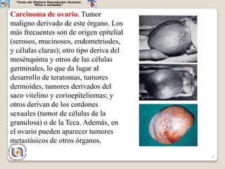 “Curso del Sistema Reproductor Humano:
             Mitos y verdades”


Carcinoma de ovario. Tumor
maligno derivado de este órgano. Los
más frecuentes son de origen epitelial
(serosos, mucinosos, endometriodes,
y células claras); otro tipo deriva del
mesénquima y otros de las células
germinales, lo que da lugar al
desarrollo de teratomas, tumores
dermoides, tumores derivados del
saco vitelino y corioepiteliomas; y
otros derivan de los cordones
sexuales (tumor de células de la
granulosa) o de la Teca. Además, en
el ovario pueden aparecer tumores
metastásicos de otros órganos.
                                          34
 