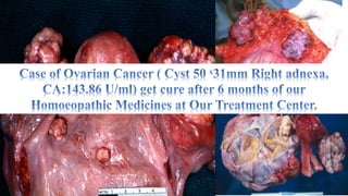 Ovarian Cancer and Homoeopathic Treatment