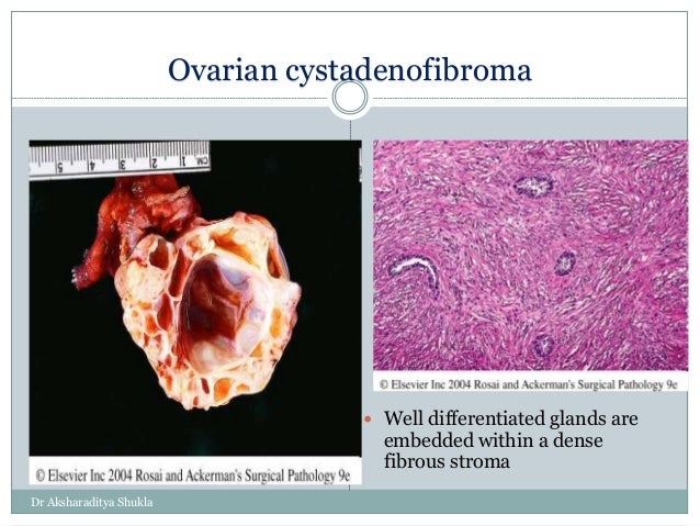Ovarian Tumors I Ovarian Tumors I