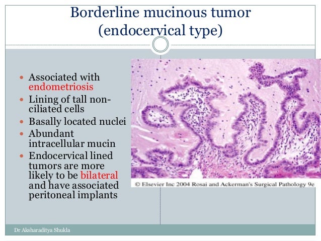 Ovarian tumors I