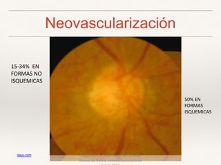 Neovascularización
15-34% EN
FORMAS NO
ISQUEMICAS
50% EN
FORMAS
ISQUEMICAS
Diagnóstico y Tratamiento de Oclusión
Venosa de Retina. México: Secretaría de
issuu.com
 