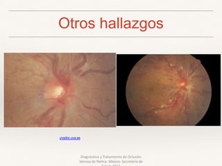 Otros hallazgos
Diagnóstico y Tratamiento de Oclusión
Venosa de Retina. México: Secretaría de
uvadoc.uva.es
 