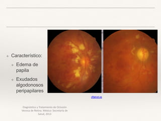 Diagnóstico y Tratamiento de Oclusión
Venosa de Retina. México: Secretaría de
Salud, 2013
❖ Característico:
❖ Edema de
papila
❖ Exudados
algodonosos
peripapilares
oftalvist.es
 