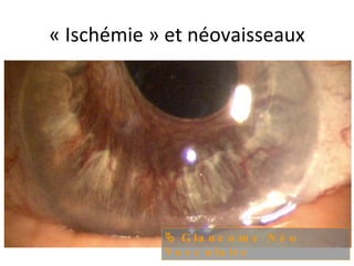 « Ischémie » et néovaisseaux Glaucome Néo Vasculaire