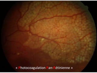 « P hotocoagulation P an- R étinienne »