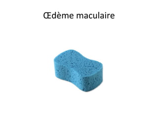 Œdème maculaire