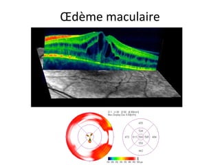 Œdème maculaire